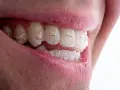 Uśmiech z przezroczystymi nakładkami Invisalign. Zastanawiasz się nad Invisalign cena? To inwestycja w prosty zgryz.