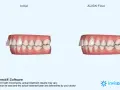 Porównanie zębów przed i po leczeniu nakładkami Invisalign. Widoczna poprawa zgryzu dzięki technologii ClinCheck.