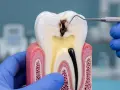 Model zęba pokazuje zaawansowaną próchnicę, która dotarła do miazgi. Dentysta w niebieskiej rękawiczce bada ubytek.