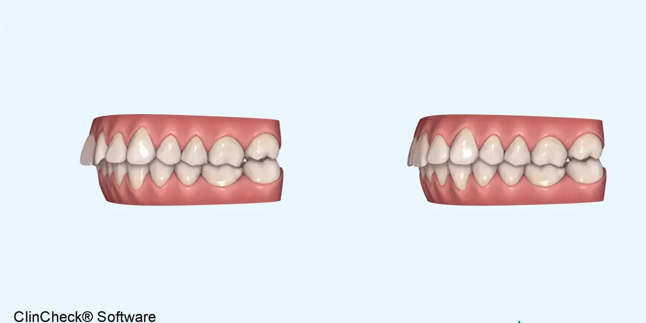 Porównanie zębów przed i po leczeniu nakładkami Invisalign. Widoczna poprawa zgryzu dzięki technologii ClinCheck.