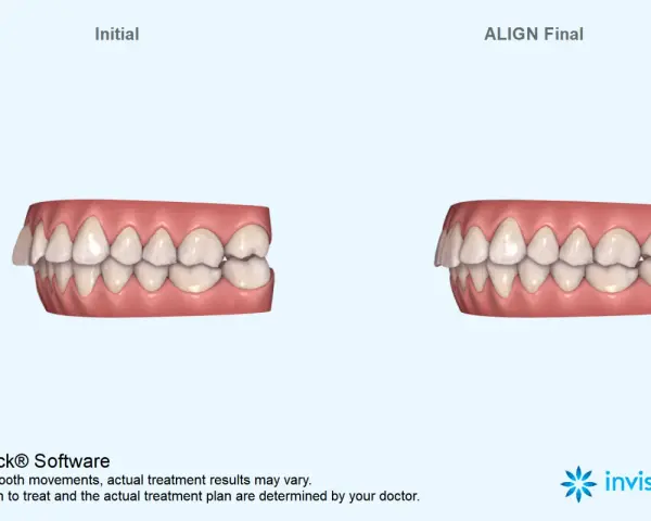 Porównanie zębów przed i po leczeniu nakładkami Invisalign. Widoczna poprawa zgryzu dzięki technologii ClinCheck.