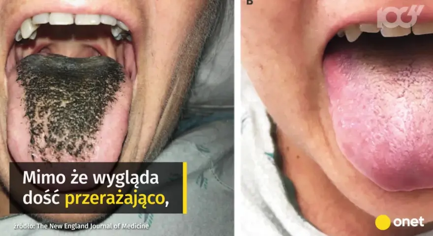 Czarny język pokryty ciemnymi włoskami, wyglądający niepokojąco, ale niegroźnie. Obok zdrowy, różowy język.