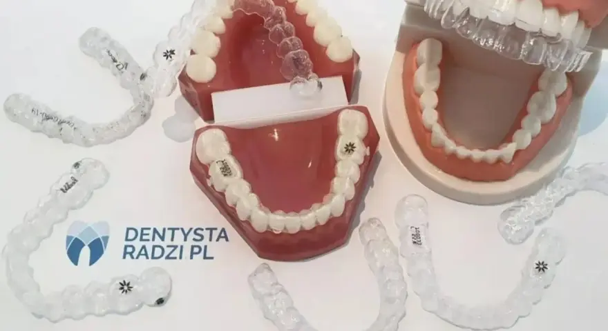 Aparat ortodontyczny: jaki wybrać? Rodzaje, koszty, wady i zalety