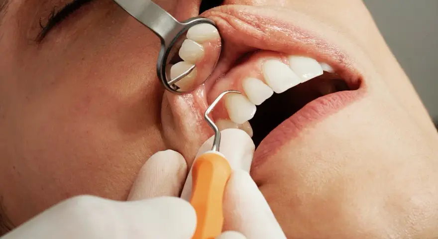 Próchnica: Kiedy domowe leczenie działa, a kiedy musisz iść do dentysty?