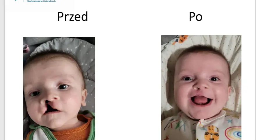 Uśmiechnięte dziecko z rozszczepem wargi przed i po operacji.