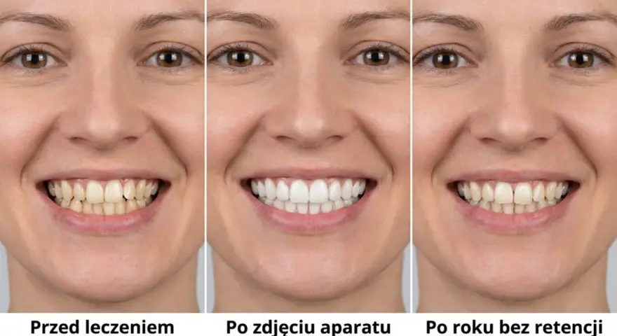 Uśmiech przed leczeniem, po zdjęciu aparatu i po roku bez retencji. Widać różnicę w prostowaniu zębów i utrzymaniu efektu.