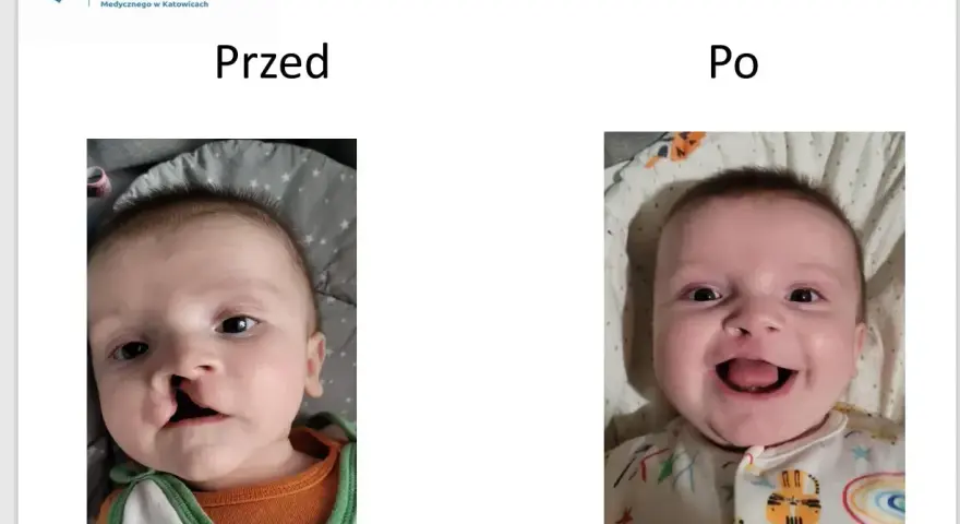 Uśmiechnięte dziecko po korekcie rozszczepu wargi. Wcześniej widoczna była zajęcza warga.