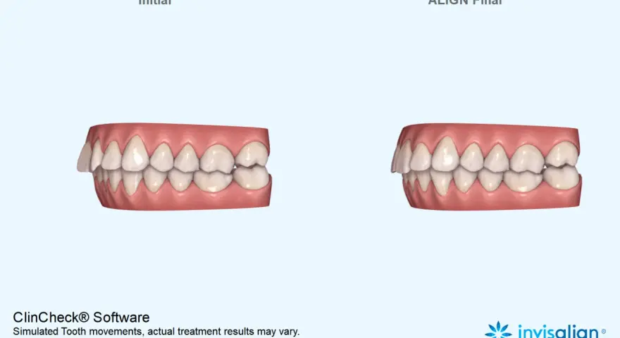 Porównanie zębów przed i po leczeniu nakładkami Invisalign. Widoczna poprawa zgryzu dzięki technologii ClinCheck.