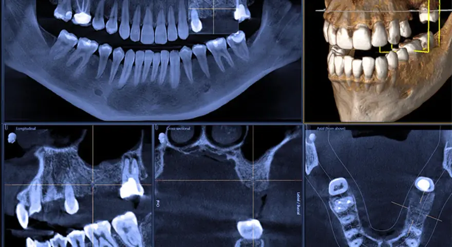 Badanie CBCT zębów: panorama, przekroje i wizualizacja 3D szczęki. Widoczne ubytki i korony.