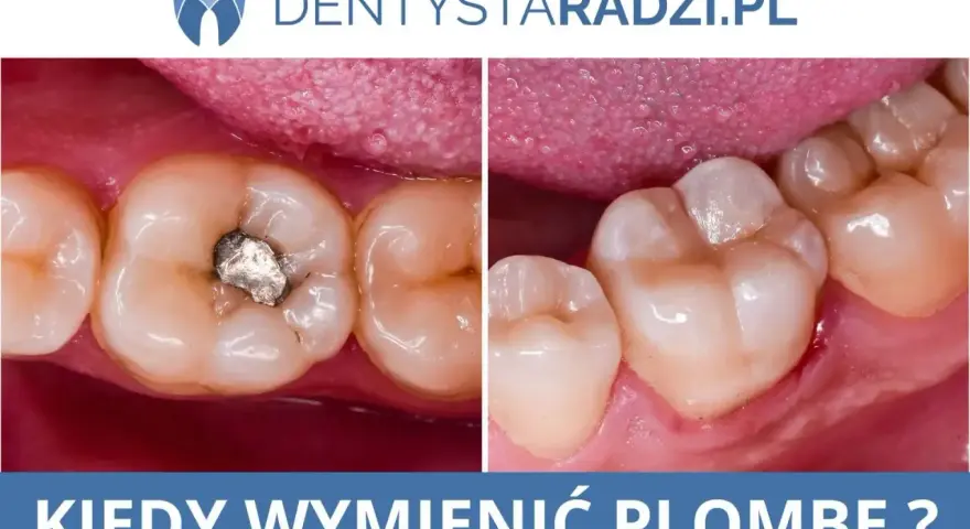 Kiedy jeść po dentyście? Poradnik: plomba, wyrwanie, wybielanie