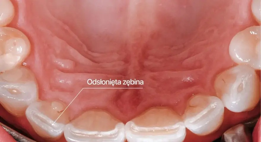Widoczne odsłonięte zęby, objaw bruksizmu. Zęby są starte, co może prowadzić do bólu i nadwrażliwości.