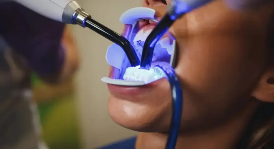 Jak wygląda wybielanie zębów u dentysty? Przewodnik krok po kroku
