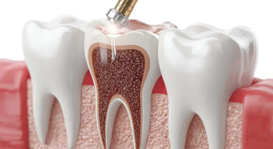 Zabieg stomatologiczny: narzędzie dentystyczne usuwa tkankę z zęba, lecząc zatrucie zęba.