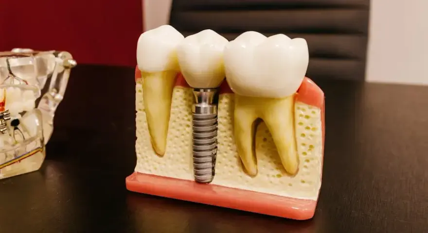 Model szczęki z zębami i mikroimplantem ortodontycznym. Implant zastępuje korzeń zęba, zapewniając stabilne podparcie dla korony.