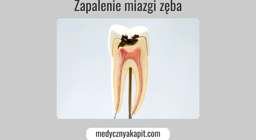 Model zęba ukazujący próchnicę sięgającą miazgi, co prowadzi do zapalenia miazgi.
