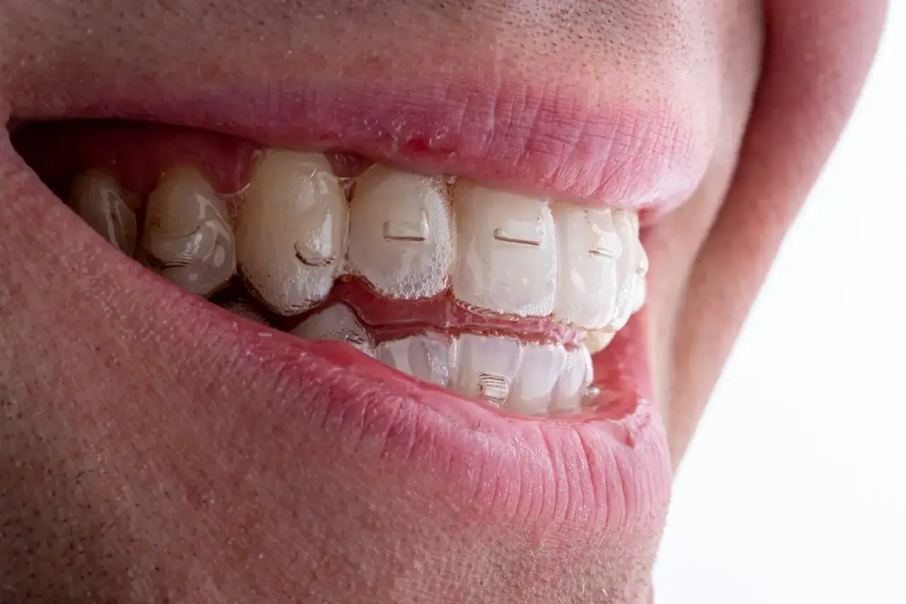 Zbliżenie na uśmiech z widocznymi, przezroczystymi nakładkami Invisalign na zębach, które korygują zgryz.