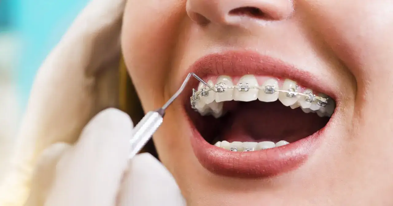 Uśmiech z aparatem ortodontycznym, zbliżenie na zęby i usta. Dentysta poprawia aparat, dążąc do prawidłowego zgryzu.