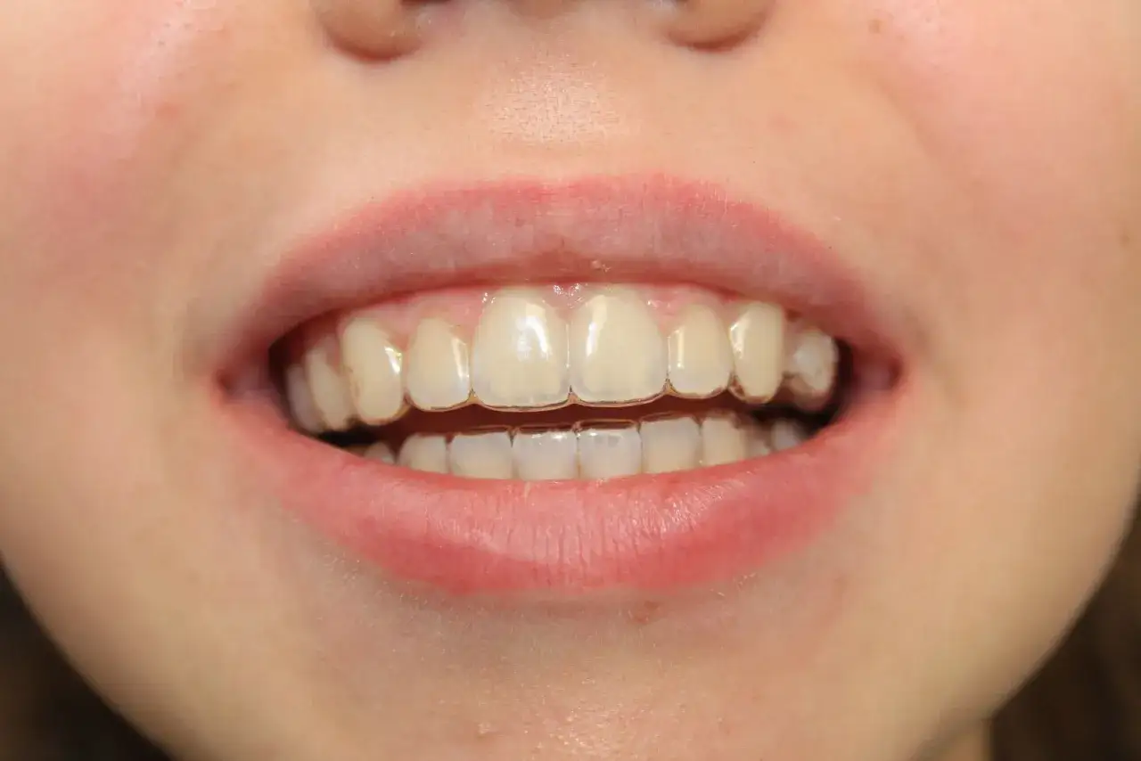 Uśmiech z dyskretnymi nakładkami Invisalign, które korygują zgryz.