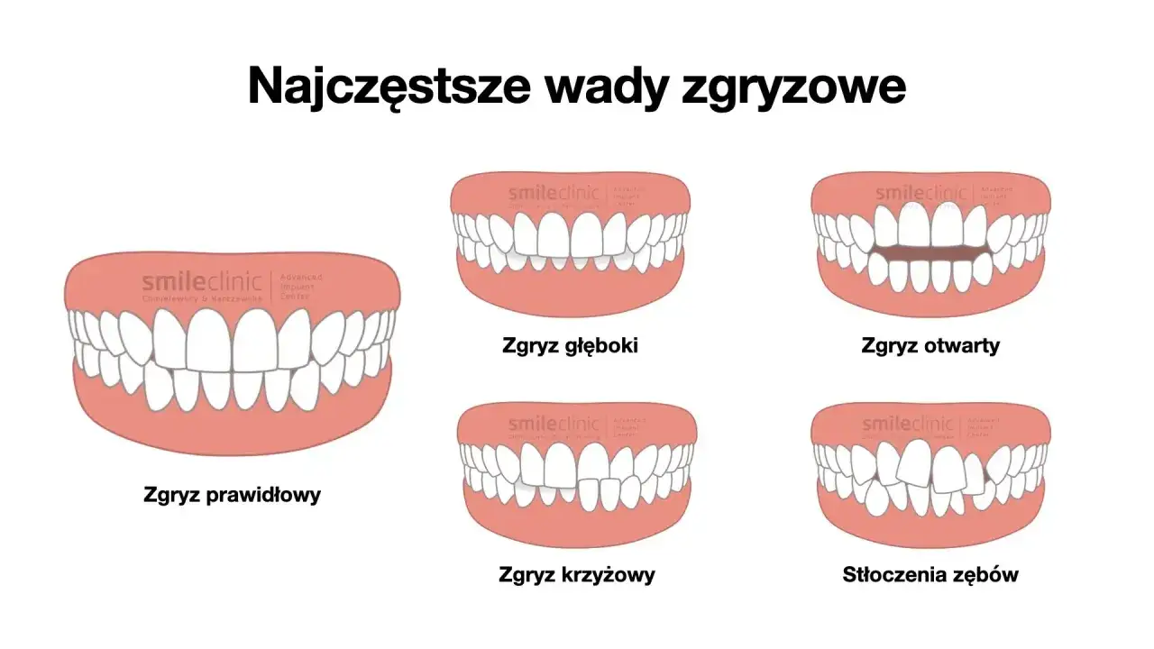Zgryz prawidłowy to idealne ułożenie zębów. Obok wady zgryzowe: głęboki, otwarty, krzyżowy i stłoczenia.