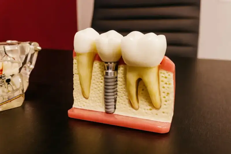 Model szczęki z zębami i mikroimplantem ortodontycznym. Implant zastępuje korzeń zęba, zapewniając stabilne podparcie dla korony.